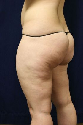 Liposuction & Safe Lipo: Case 33 - Before