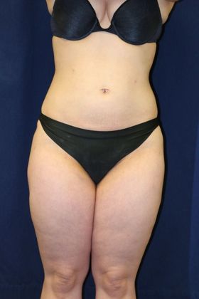 Liposuction & Safe Lipo Case 33 - After