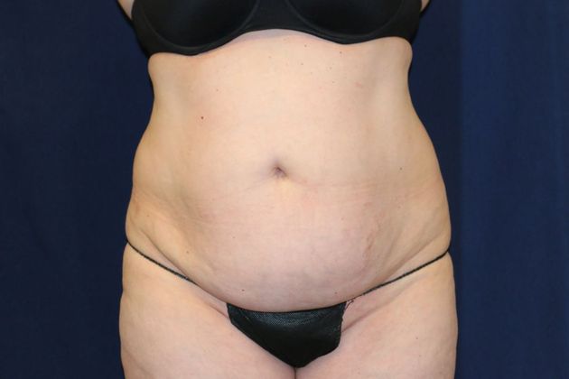 Liposuction & Safe Lipo: Case 35 - Before