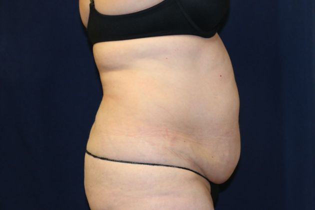Liposuction & Safe Lipo: Case 35 - Before