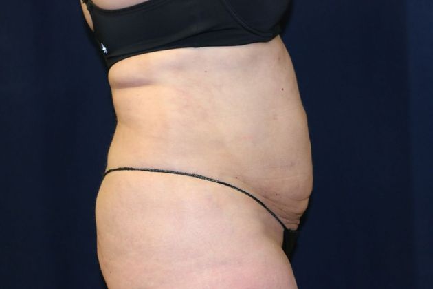 Liposuction & Safe Lipo: Case 35 - After