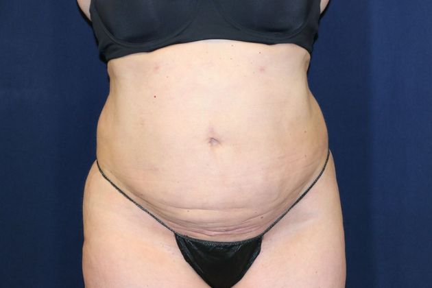 Liposuction & Safe Lipo: Case 35 - After