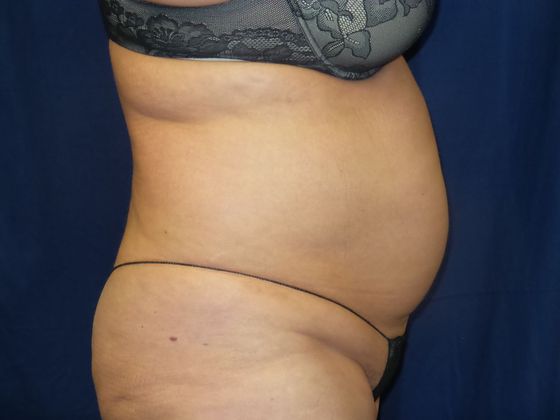 Liposuction & Safe Lipo: Case 36 - Before