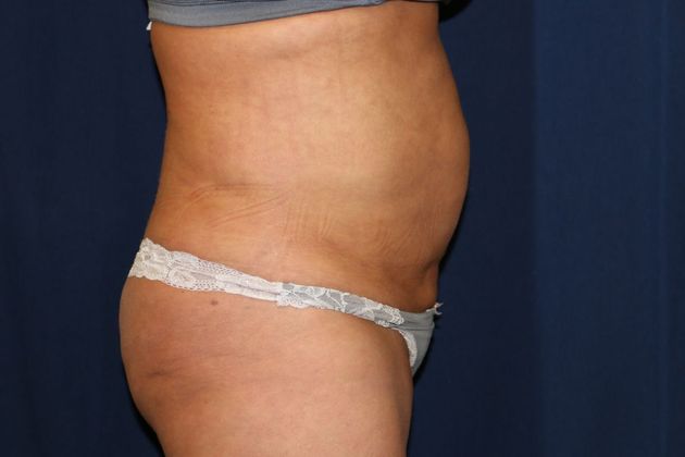Liposuction & Safe Lipo: Case 36 - After