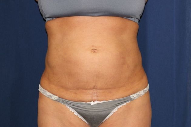 Liposuction & Safe Lipo: Case 36 - After