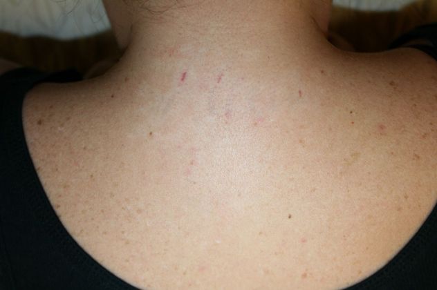 Tattoo Removal : Tattoo Removal 1 - After