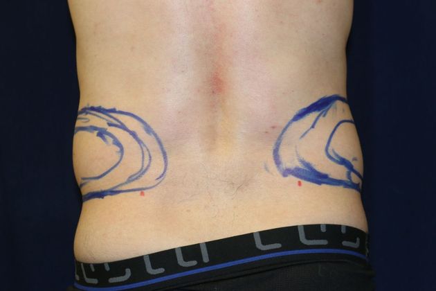 Liposuction & Safe Lipo: Case 37 - Before