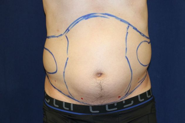 Liposuction & Safe Lipo: Case 37 - Before