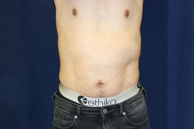 Liposuction & Safe Lipo: Case 37 - After