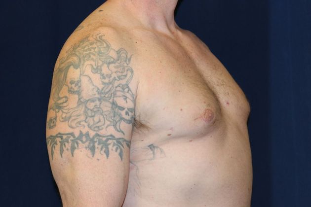 Male Breast Reduction*: Case 5 - Before