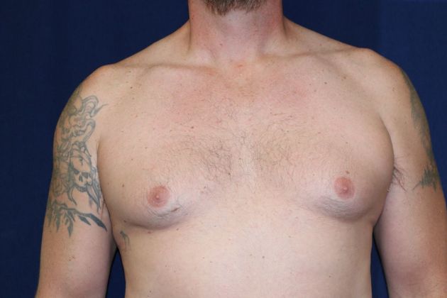 Male Breast Reduction* Case 5 - Before