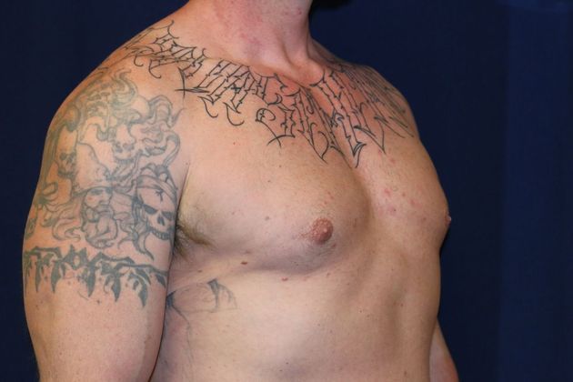 Male Breast Reduction*: Case 5 - After