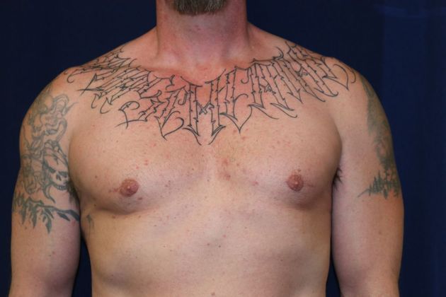 Male Breast Reduction* Case 5 - After