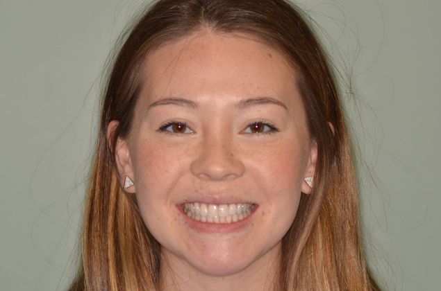 Invisalign: Case 8 - After