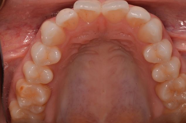 Invisalign: Case 8 - Before