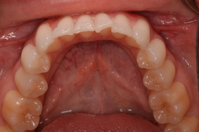 Invisalign: Case 8 - Before