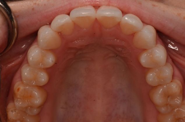 Invisalign: Case 8 - After