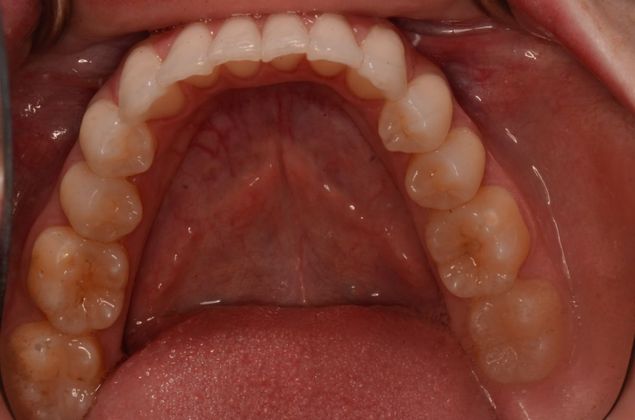Invisalign: Case 8 - After