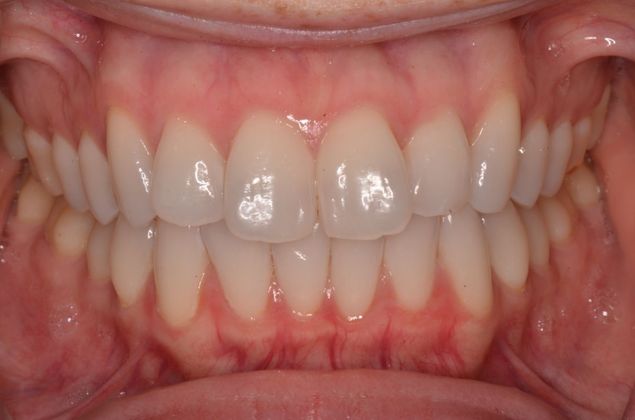 Invisalign: Case 8 - Before