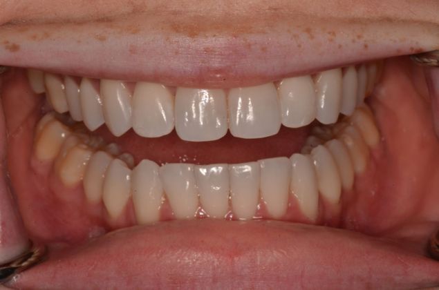 Invisalign: Case 8 - After