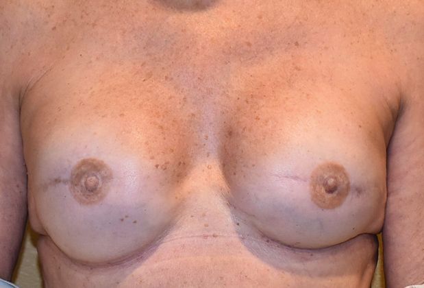 Breast Reconstruction Case 63 - After