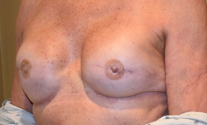Breast Reconstruction: Case 63 - After