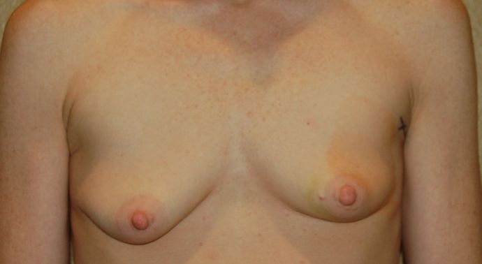 Breast Reconstruction Case 64 - Before