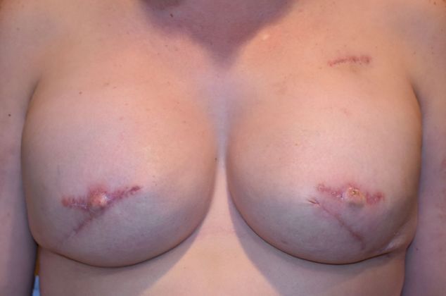 Breast Reconstruction Case 65 - After