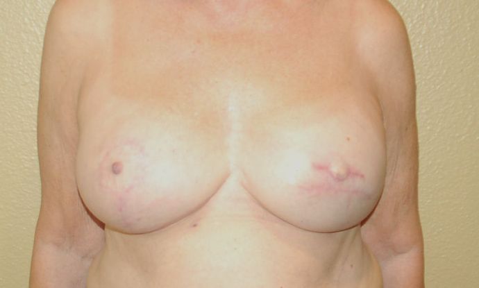 Breast Reconstruction Case 66 - After