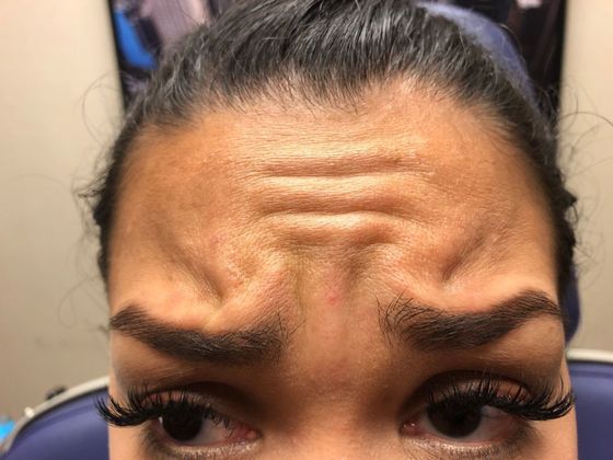 BOTOX® Cosmetic*: Case 4 - Before