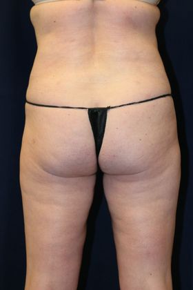 Liposuction & Safe Lipo: Case 31 - After