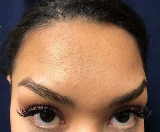 BOTOX® Cosmetic*: Case 4 - After