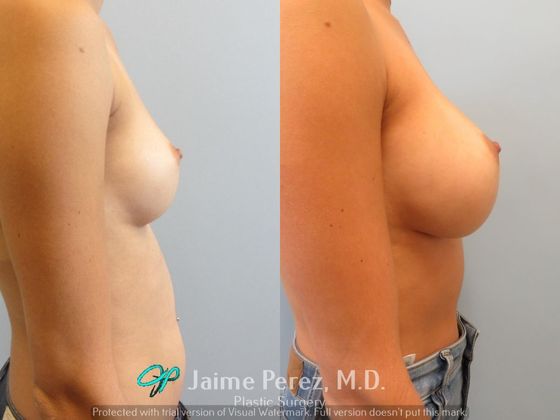 Breast Augmentation: 32-year-old female: Saline Breast Augmentation - Before & After