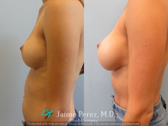 Breast Augmentation: 32-year-old female: Saline Breast Augmentation - Before & After