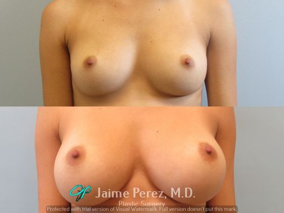 Breast Augmentation: 32-year-old female: Saline Breast Augmentation - Before & After