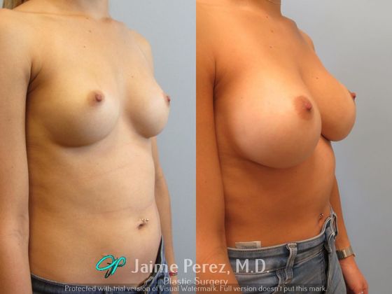 Breast Augmentation: 32-year-old female: Saline Breast Augmentation - Before & After