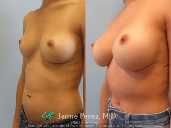 Breast Augmentation: 32-year-old female: Saline Breast Augmentation - Before & After