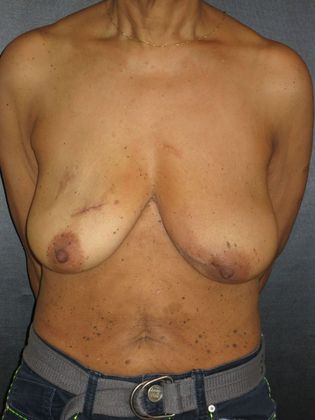 Breast Reconstruction - Implants: Case 4 - Before