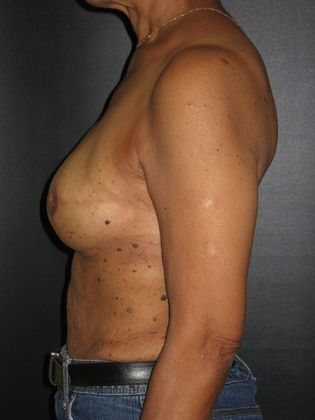 Breast Reconstruction - Implants: Case 4 - After