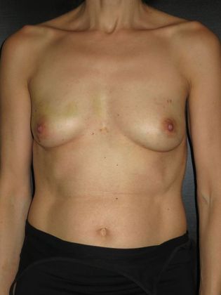 Breast Reconstruction - Implants Case 5 - Before