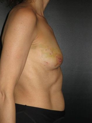 Breast Reconstruction - Implants: Case 5 - Before