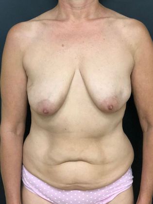 DIEP Flap (natural tissue) Breast Reconstruction Case 6 - DIEP flap breast reconstruction after double mastectomy. Breast lift technique. Nipple Sparing - Before