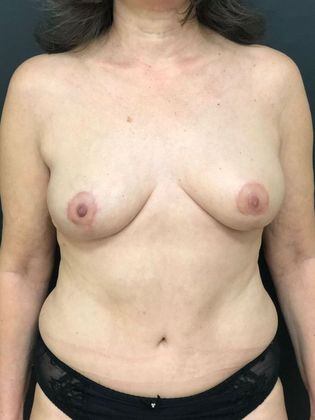 DIEP Flap (natural tissue) Breast Reconstruction Case 6 - DIEP flap breast reconstruction after double mastectomy. Breast lift technique. Nipple Sparing - After