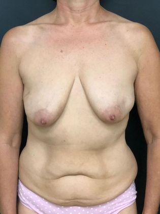 Breast Lift Case 3 - Before