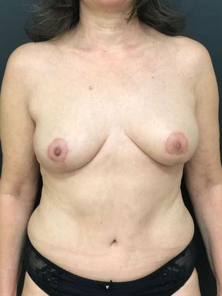 Breast Lift Case 3 - After
