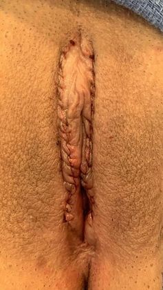 Labiaplasty: Case 15- New Milford, CT - After