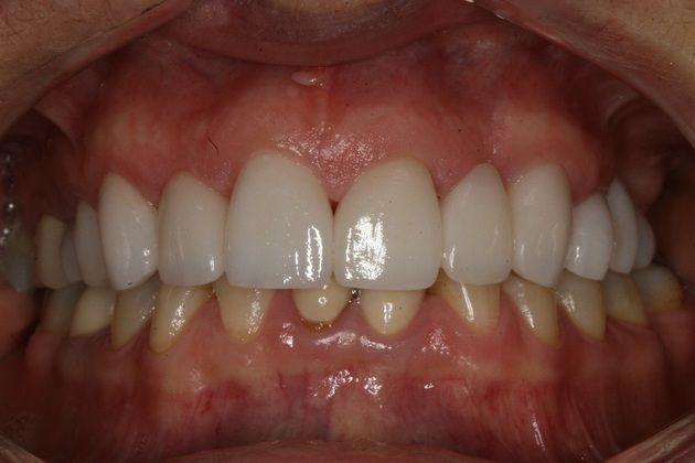 Porcelain Veneers Smile Makeover - After