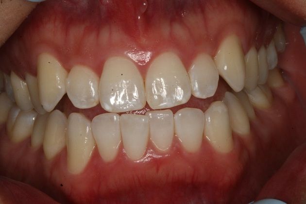 Bonding for Aesthetics Bonding of Anterior - Before