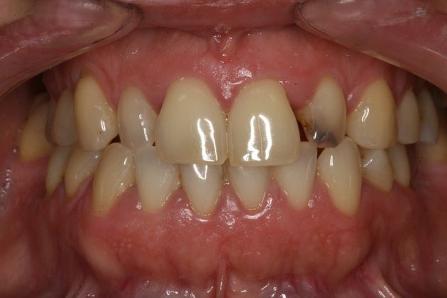 Porcelain Veneers Porcelain Veneers for her Smile - Before