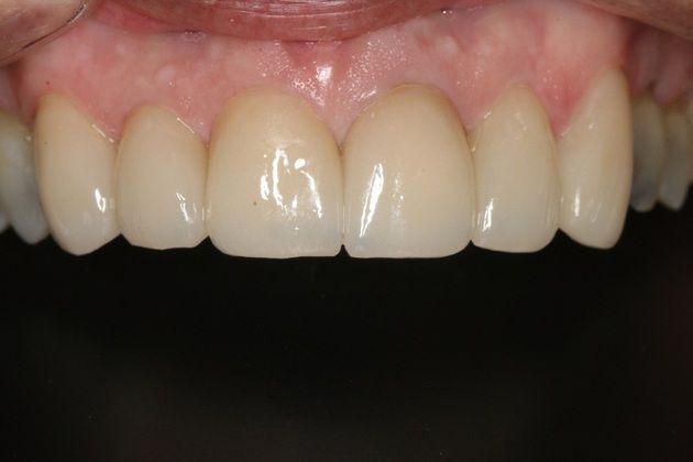 Porcelain Veneers Upper porcelain veneers - After